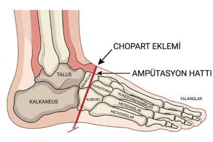 Chopart Amputasyonu Nedir?